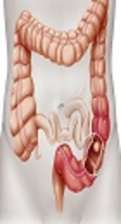 The Relationship Between Blood Group and Colon Cancer in Shiraz Namazi Hospital During 2002 - 2011